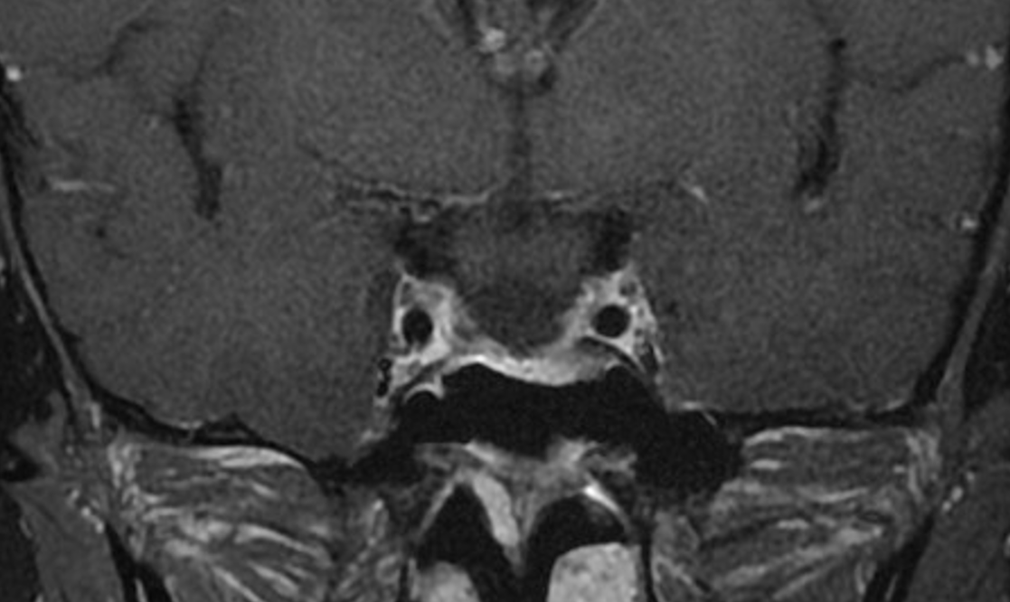 男人手掌大才是好福氣？腦下垂體腫瘤導致肢端肥大症 馬偕腦瘤微創手術團隊解決病人困擾說明圖片