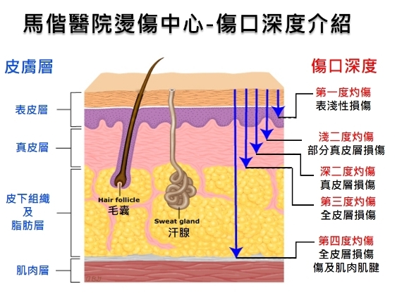 傷口深度示意圖